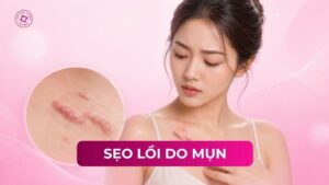 sẹo lồi do mụn