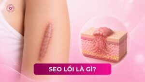 sẹo lồi là gì