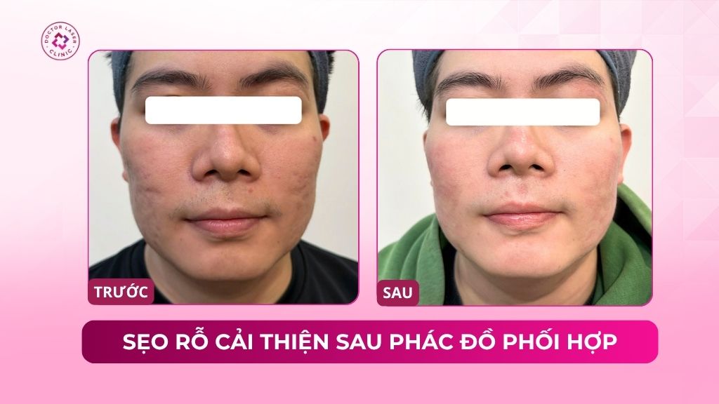 sẹo rỗ cải thiện sau phác đồ phối hợp