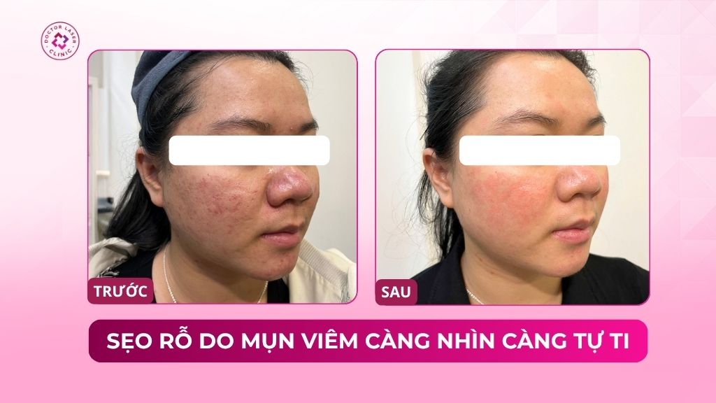 sẹo rỗ do mụn viêm càng nhìn càng tự ti