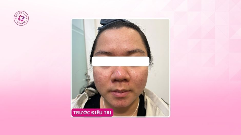 sẹo rỗ do mụn viêm trước điều trị