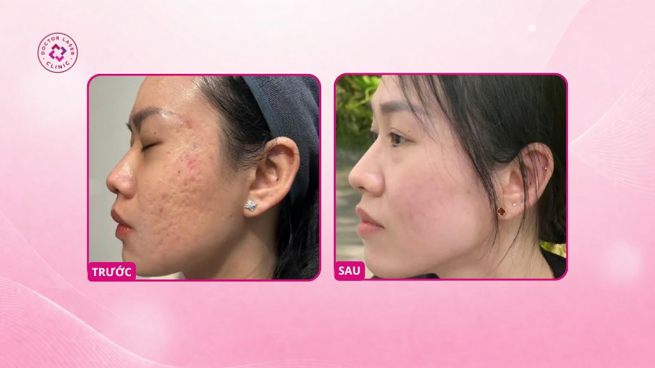 sẹo rỗ hai bên má sau điều trị doctor laser