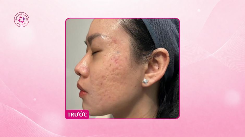 sẹo rỗ hai bên má trước điều trị doctor laser