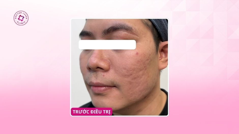 sẹo rỗ hai bên má trước điều trị