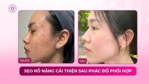 sẹo rỗ nặng hai bên má cải thiện sau phác đồ phối hợp
