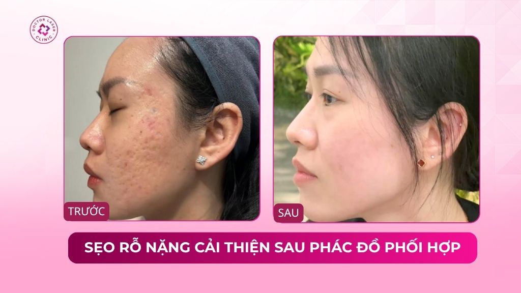 sẹo rỗ nặng hai bên má cải thiện sau phác đồ phối hợp