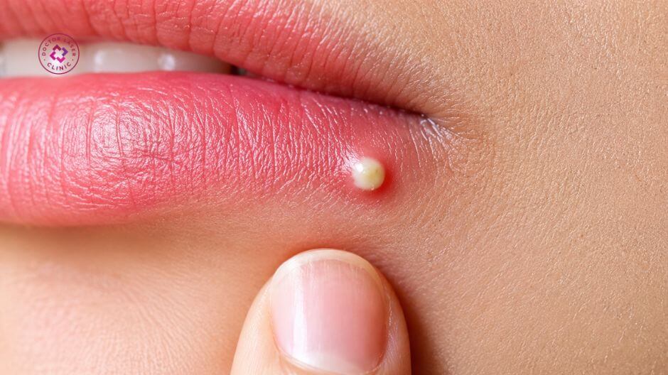 thay đổi nội tiết tố gây mụn trứng cá quanh miệng