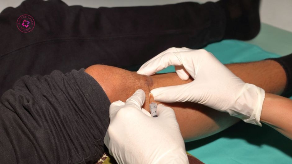 tiêm corticoid nội sẹo lồi