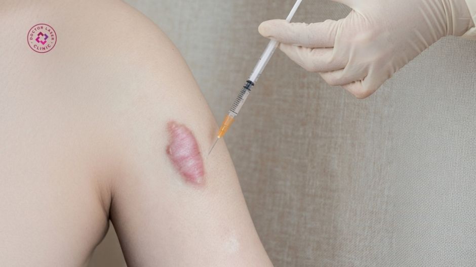 tiêm corticosteroid điều trị sẹo lồi