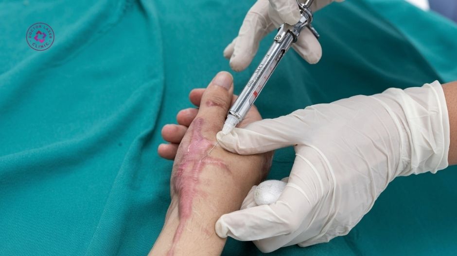 tiêm corticosteroid nội tổn thương trị sẹo lồi trên mặt