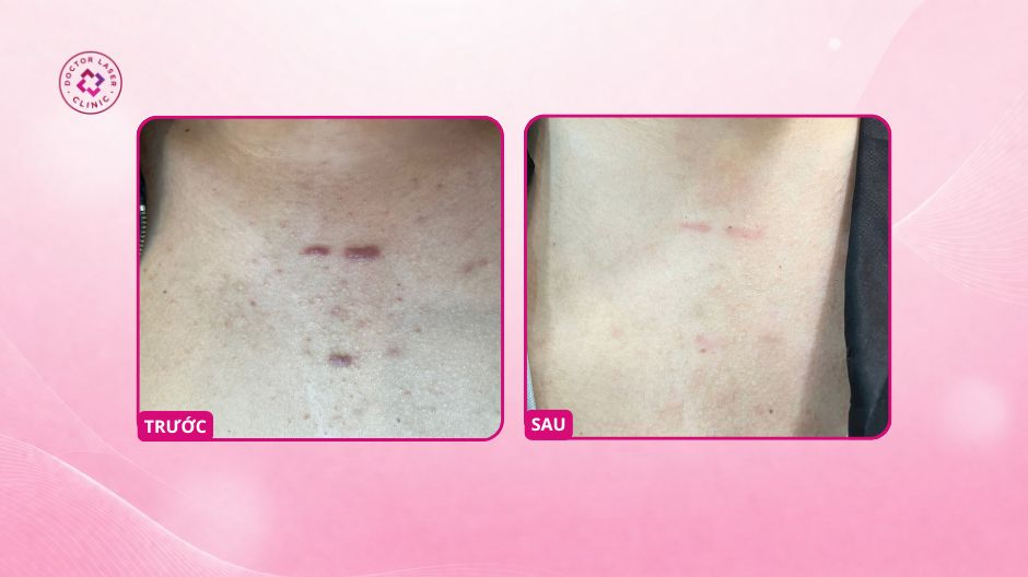 trước sau tiêm sẹo lồi vùng ngực doctor laser