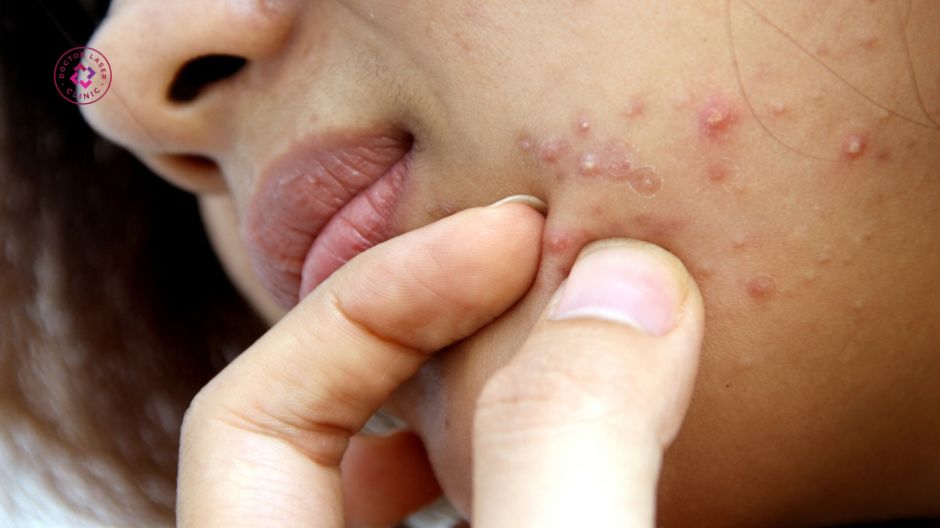 tự nặn mụn cạy mụn sai cách gây sẹo lồi