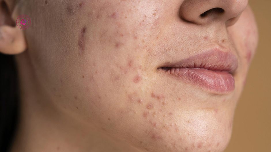 ai phù hợp lăn kim trị thâm mụn