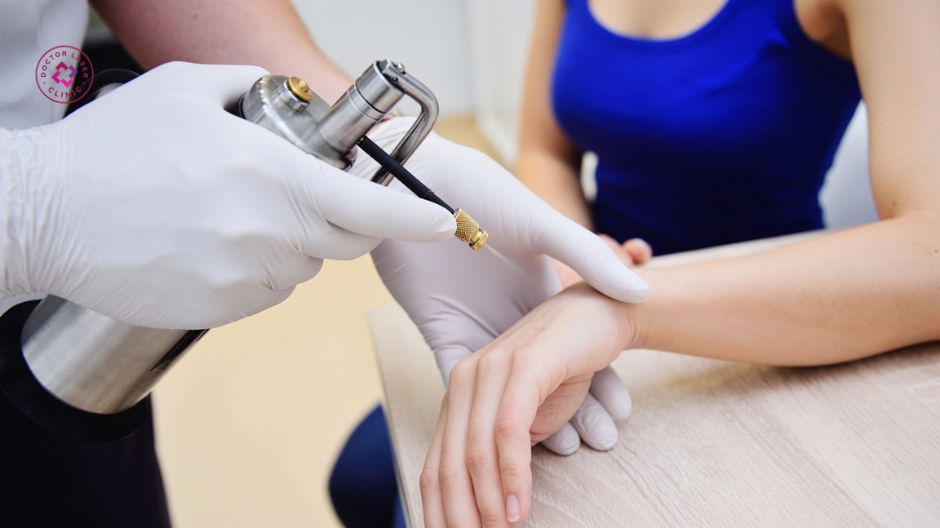 áp lạnh điều trị sẹo lồi