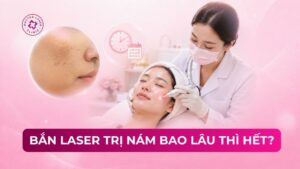 bắn laser trị nám bao lâu thì hết