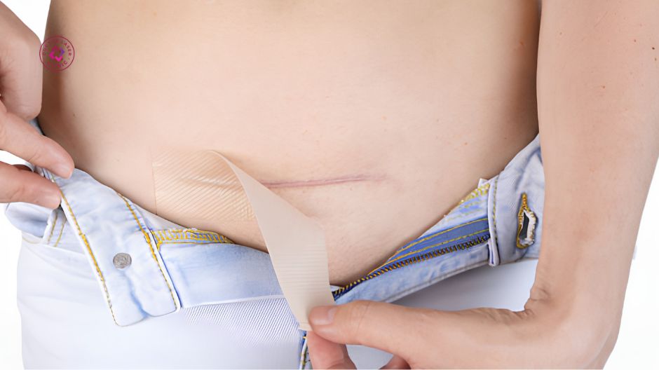 băng ép và gel silicone hỗ trợ điều trị sẹo mổ đẻ bị lồi