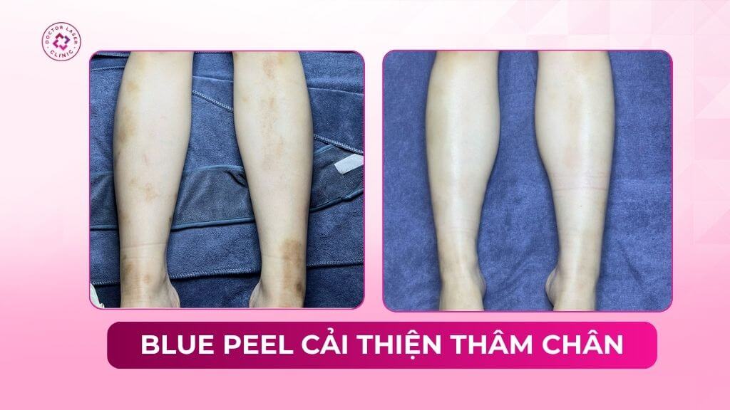 blue peel cải thiện thâm chân
