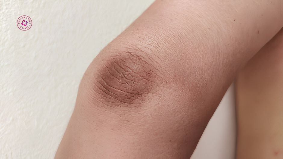 các yếu tố ảnh hưởng đến hiệu quả trị thâm khuỷu tay