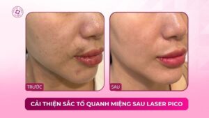 cải thiện sắc tố quanh miệng sau laser pico