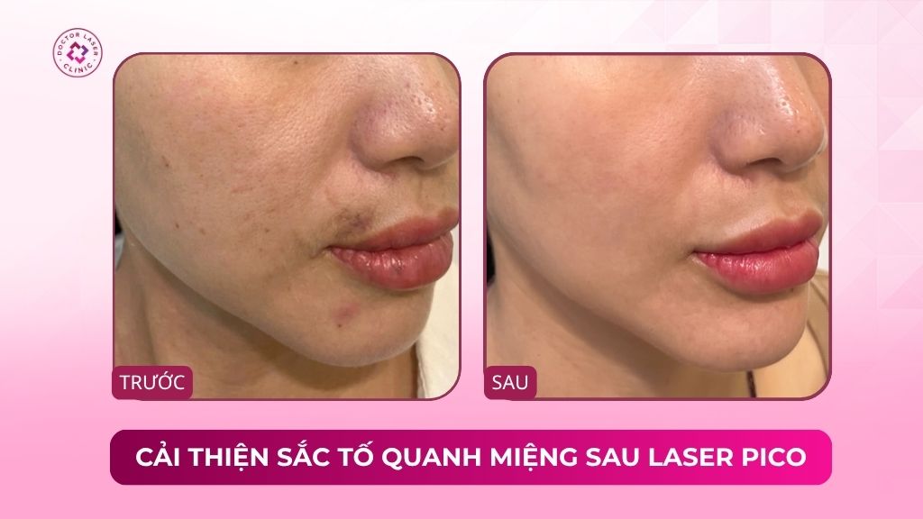cải thiện sắc tố quanh miệng sau laser pico