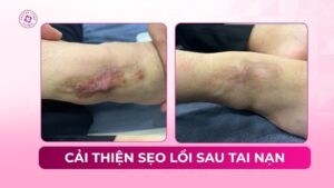 cải thiện sẹo lồi sau tai nạn