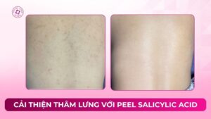 cải thiện thâm lưng với peel salicylic acid