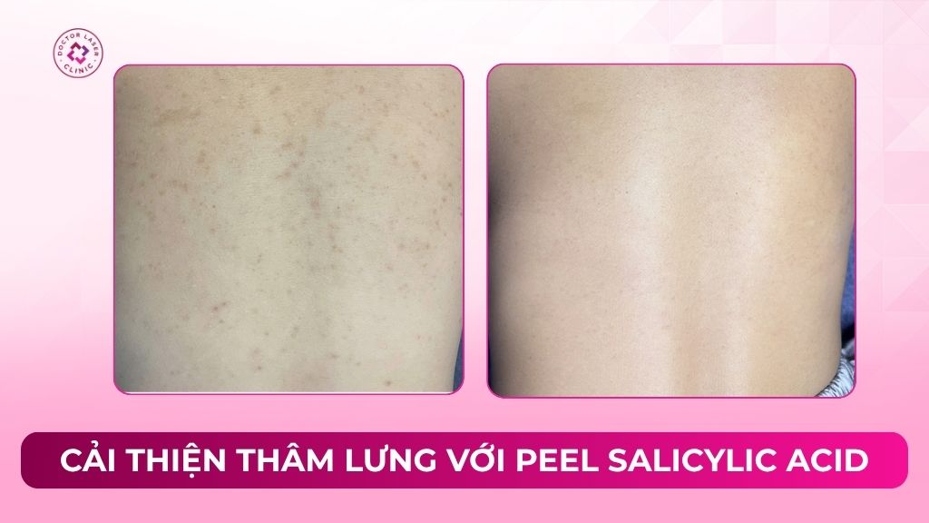 cải thiện thâm lưng với peel salicylic acid
