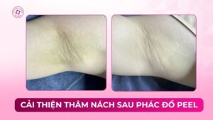 cải thiện thâm nách sau phác đồ peel da