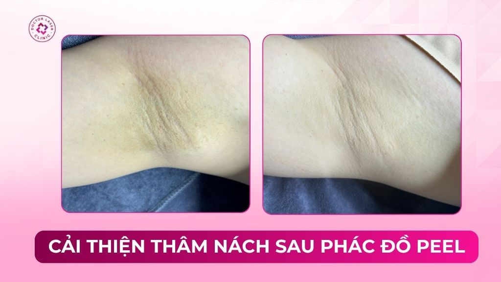 cải thiện thâm nách sau phác đồ peel da