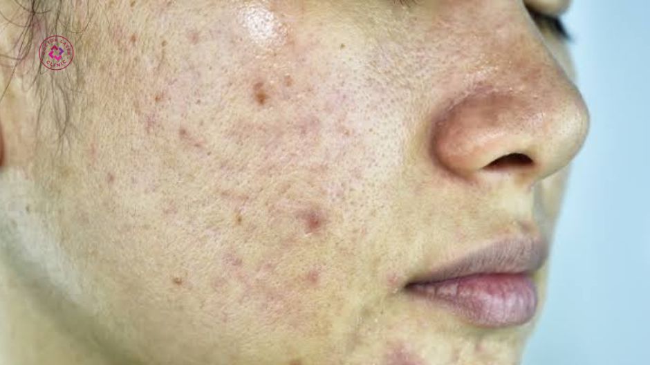cơ chế tác động khi bắn laser trị thâm mụn