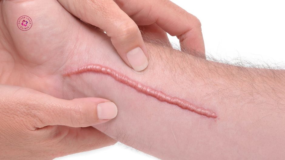 cơ địa dễ hình thành sẹo lồi đỏ