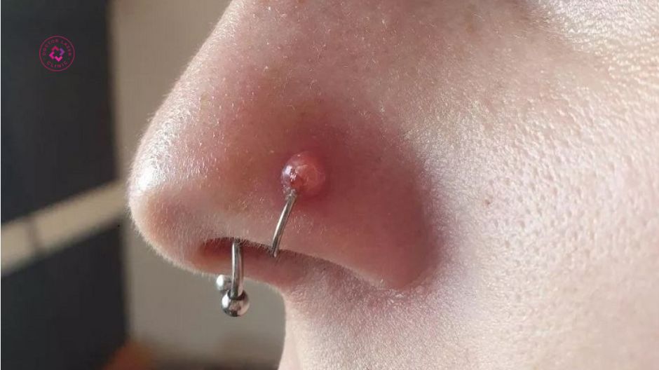 cơ địa và di truyền gây sẹo lồi xỏ khuyên