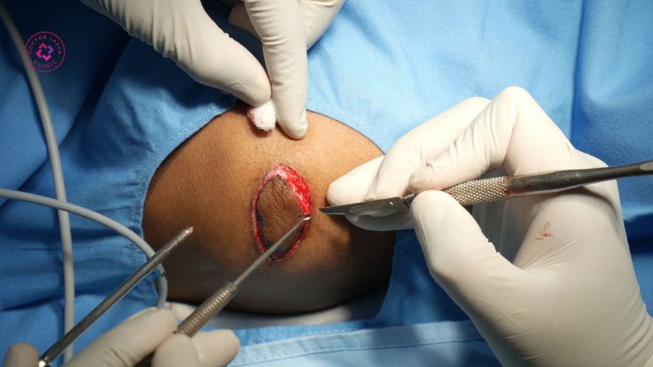 có nên cắt sẹo lồi không