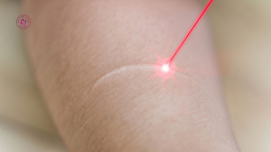 công nghệ laser điều trị sẹo lồi trắng