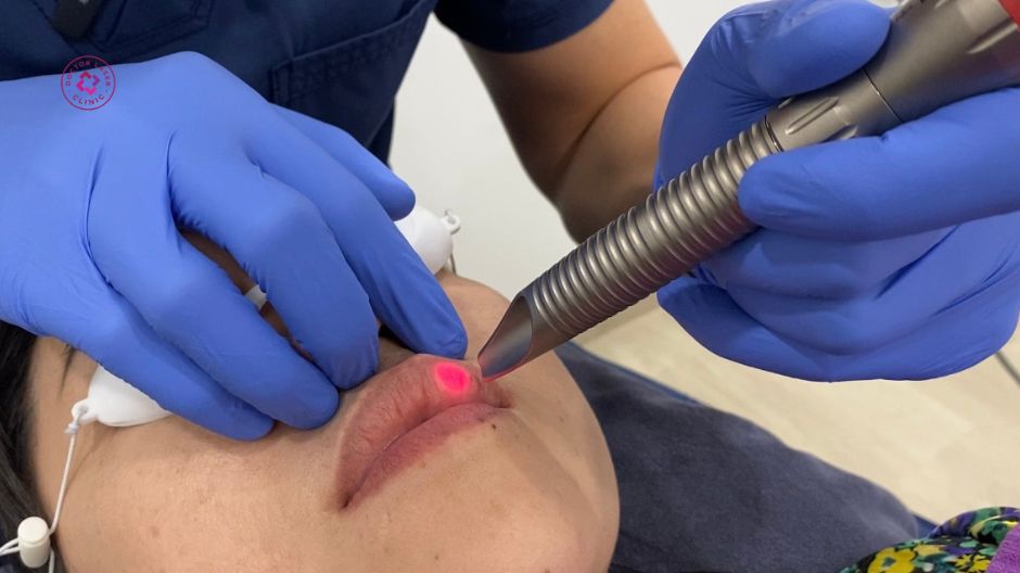 công nghệ laser hỗ trợ khử thâm môi