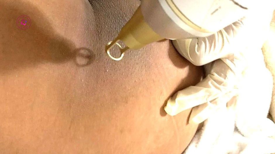 công nghệ laser trị thâm mông