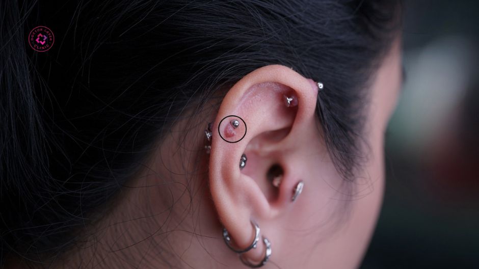 dấu hiệu nhận biết sẹo lồi xỏ khuyên
