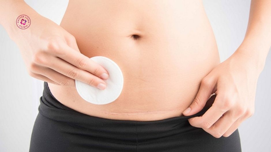 giữ vùng điều trị khô sau khi trị sẹo lồi mổ đẻ