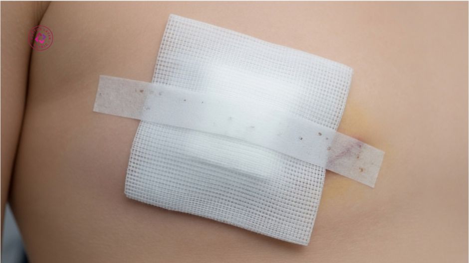 giữ vùng phẫu thuật sạch và khô sau cắt sẹo lồi