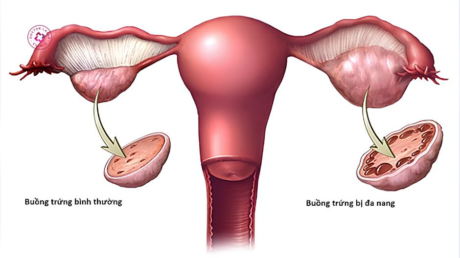 hội chứng buồng trứng đa nang gây mụn nội tiết