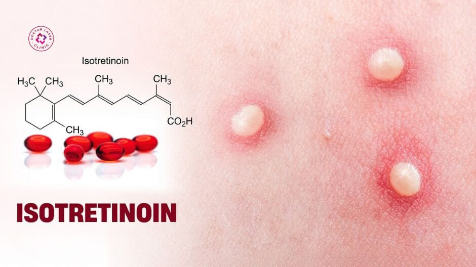 isotretinoin trong điều trị mụn nặng
