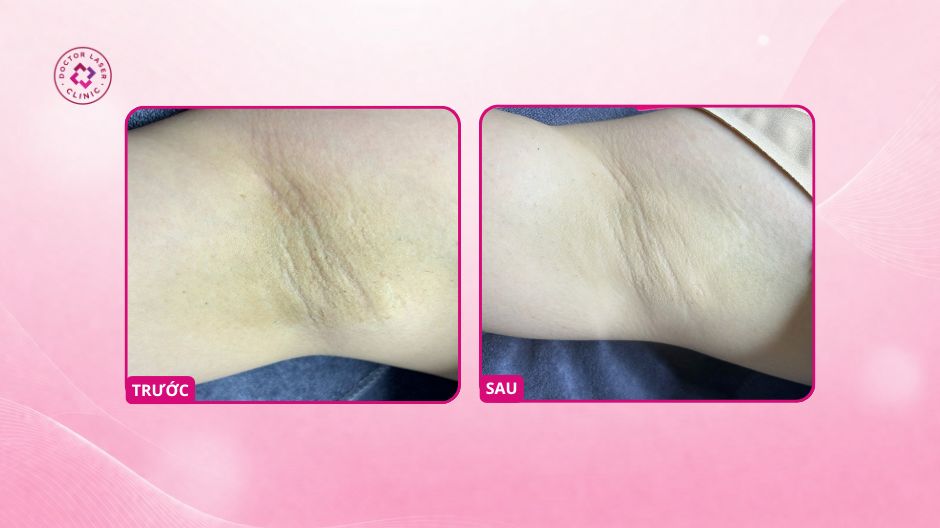 kết quả cải thiện thâm nách sau peel