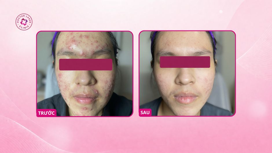 kết quả mụn viêm sau peel da