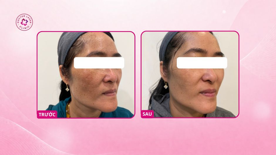 kết quả nám sau 3 lần điều trị laser pico