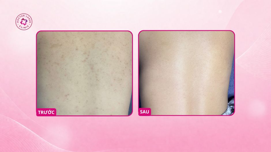 kết quả thâm lưng sau peel salicylic acid