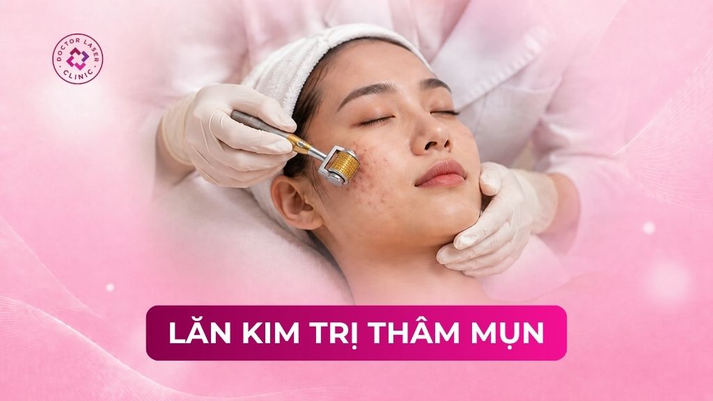 Lăn kim trị thâm mụn là gì? Quy trình và thời gian hồi phục