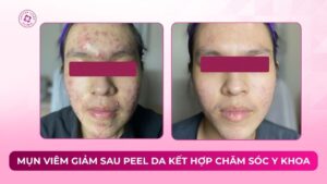 mụn viêm giảm sau peel da kết hợp chăm sóc y khoa
