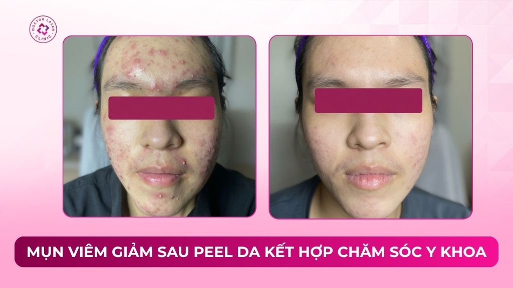 mụn viêm giảm sau peel da kết hợp chăm sóc y khoa