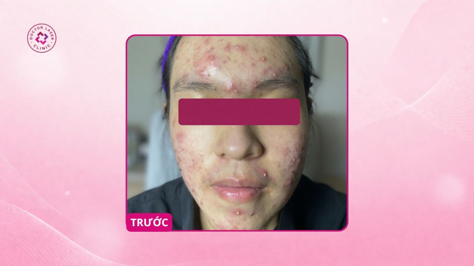 mụn viêm trước khi peel da