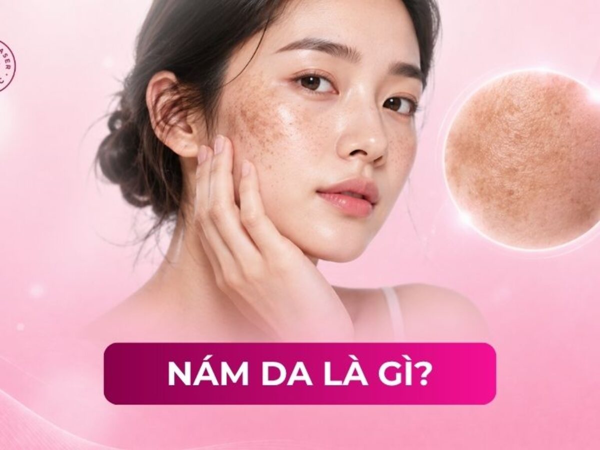 Nám da là gì? Phân loại, nguyên nhân và cách phòng ngừa